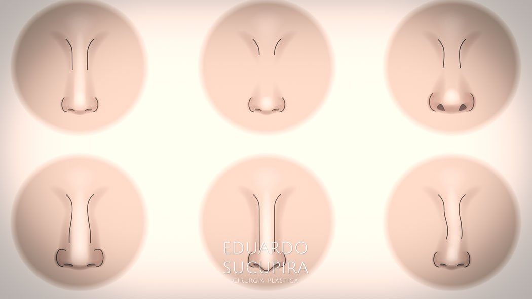 Antes e Depois da Rinoplastia
