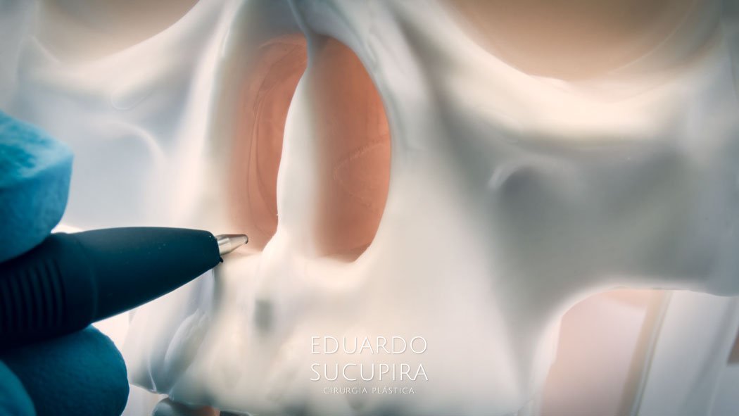 Cirurgia de Desvio de Septo e Rinoplastia
